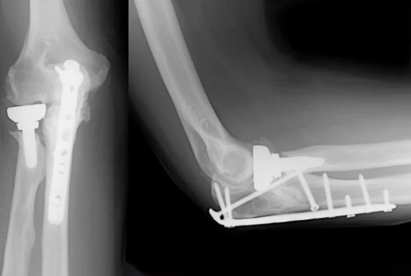 Complex Fractures