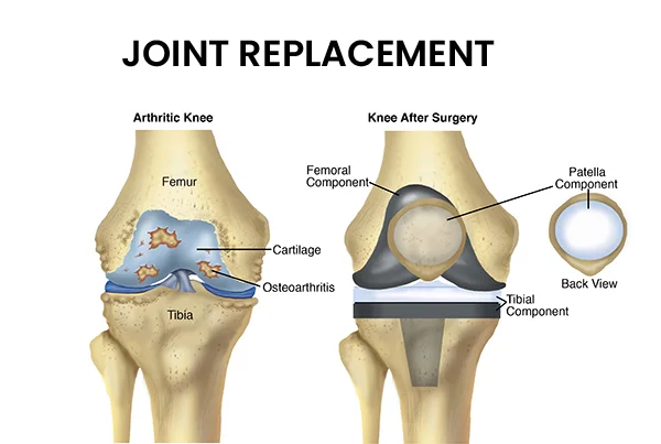 Joint Replacement