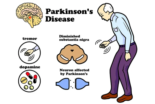 Parkinson