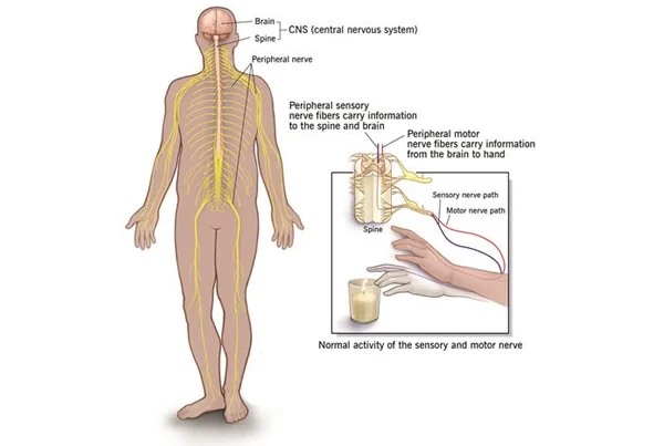 Neuropathy